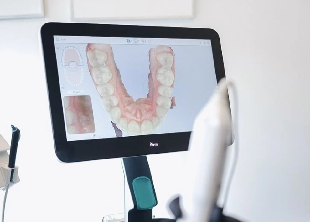 Escaneo digital dental