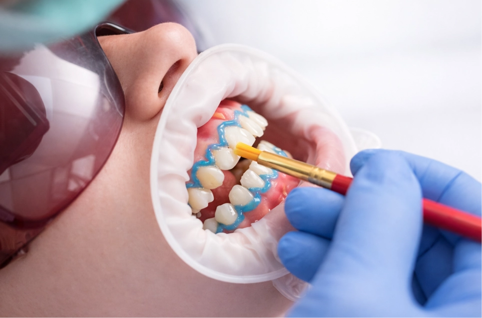 Blanqueamiento dental